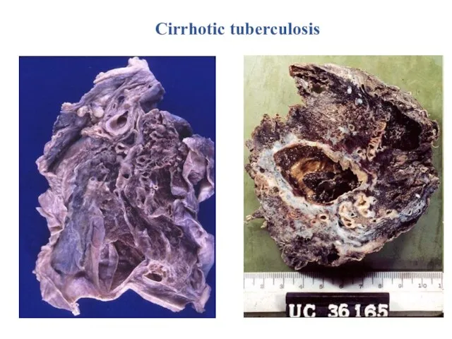 Cirrhotic tuberculosis