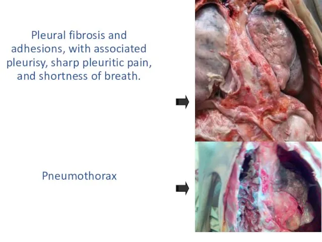 Pleural fibrosis and adhesions, with associated pleurisy, sharp pleuritic pain, and shortness of breath. Pneumothorax