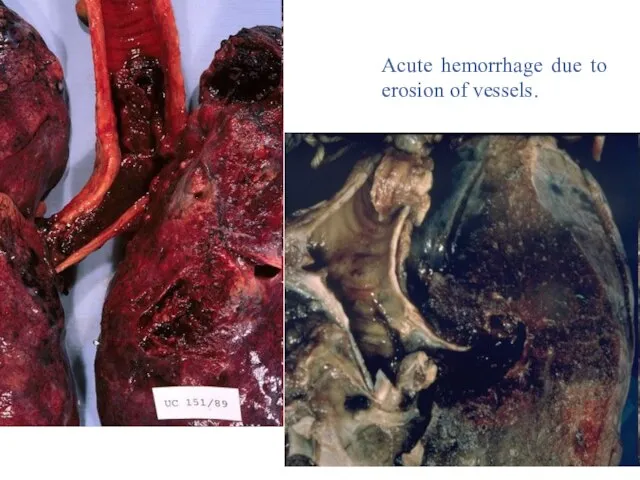 Acute hemorrhage due to erosion of vessels.
