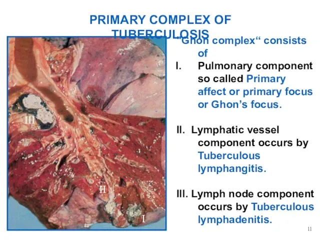 PRIMARY COMPLEX OF TUBERCULOSIS "Ghon complex“ consists of Pulmonary component so