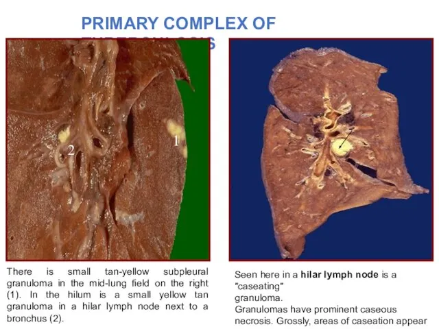 There is small tan-yellow subpleural granuloma in the mid-lung field on