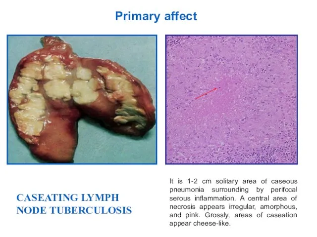 It is 1-2 cm solitary area of caseous pneumonia surrounding by