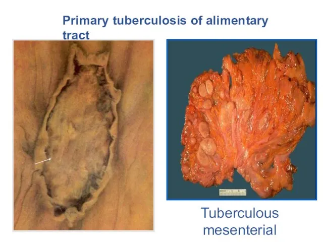 Primary tuberculosis of alimentary tract Tuberculous mesenterial lymphadenitis