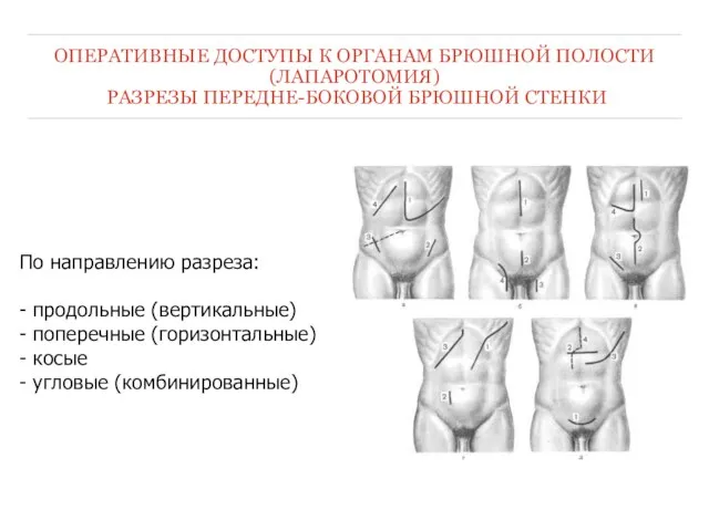 ОПЕРАТИВНЫЕ ДОСТУПЫ К ОРГАНАМ БРЮШНОЙ ПОЛОСТИ (ЛАПАРОТОМИЯ) РАЗРЕЗЫ ПЕРЕДНЕ-БОКОВОЙ БРЮШНОЙ СТЕНКИ