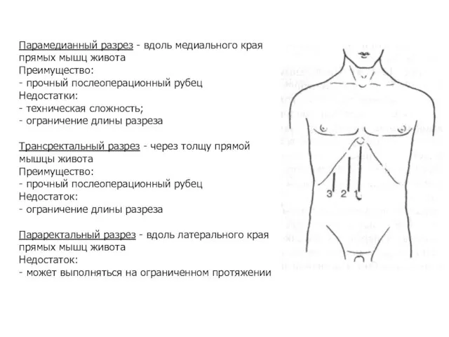 Парамедианный разрез - вдоль медиального края прямых мышц живота Преимущество: -