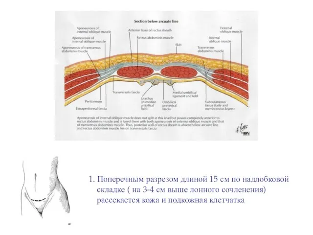 1. Поперечным разрезом длиной 15 см по надлобковой складке ( на
