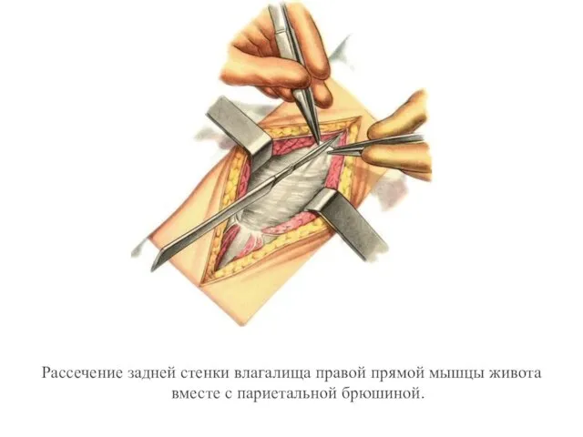 Рассечение задней стенки влагалища правой прямой мышцы живота вместе с париетальной брюшиной.