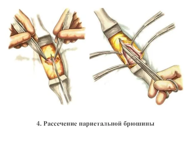 4. Рассечение париетальной брюшины