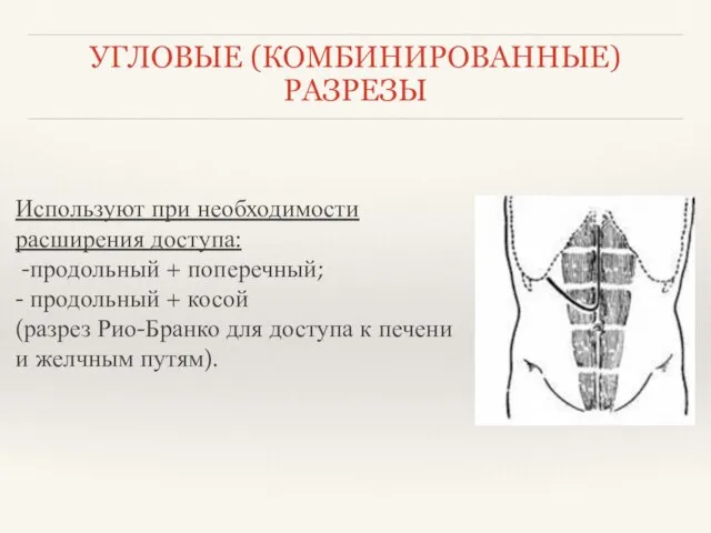 Используют при необходимости расширения доступа: -продольный + поперечный; - продольный +