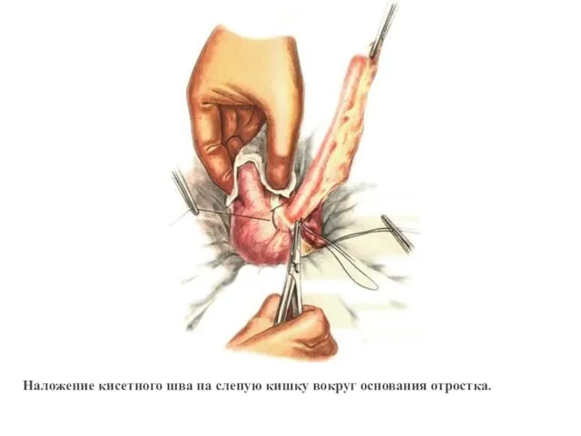 Наложение кисетного шва на слепую кишку вокруг основания отростка.