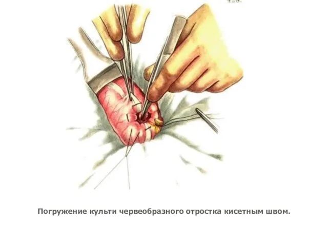 Погружение культи червеобразного отростка кисетным швом.