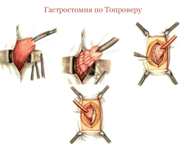 Гастростомия по Топроверу