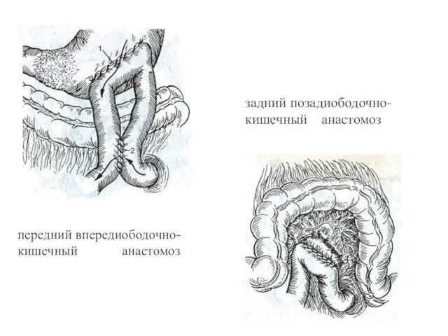 передний впередиободочно-кишечный анастомоз задний позадиободочно-кишечный анастомоз