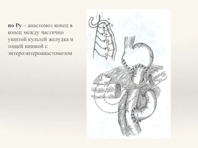 по Ру – анастомоз конец в конец между частично ушитой культей