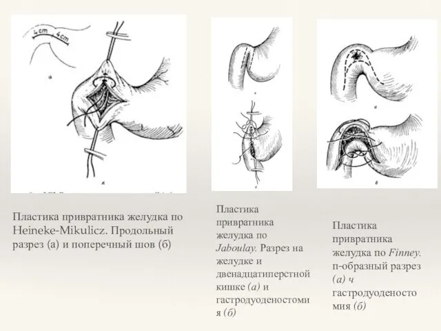 Пластика привратника желудка по Heineke-Mikulicz. Продольный разрез (а) и поперечный шов