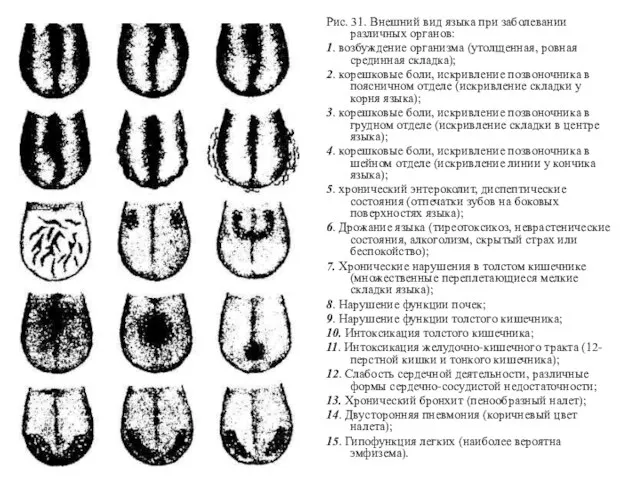 Рис. 31. Внешний вид языка при заболевании различных органов: 1. возбуждение