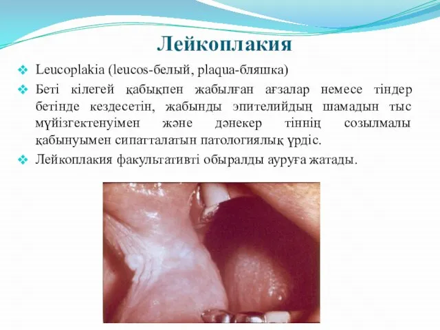 Лейкоплакия Leucoplakia (leucos-белый, plaqua-бляшка) Беті кілегей қабықпен жабылған ағзалар немесе тіндер