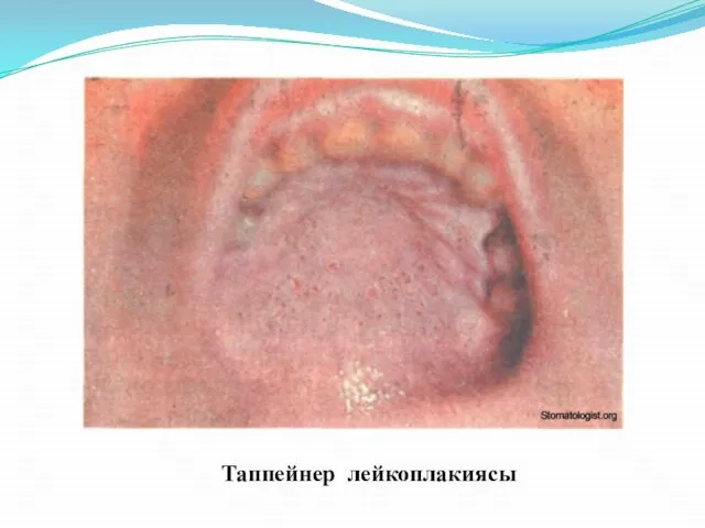 Таппейнер лейкоплакиясы