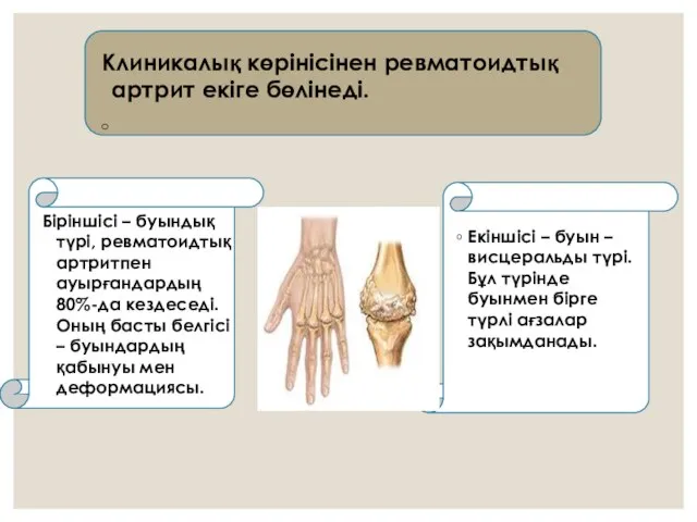 Клиникалық көрінісінен ревматоидтық артрит екіге бөлінеді. Біріншісі – буындық түрі, ревматоидтық