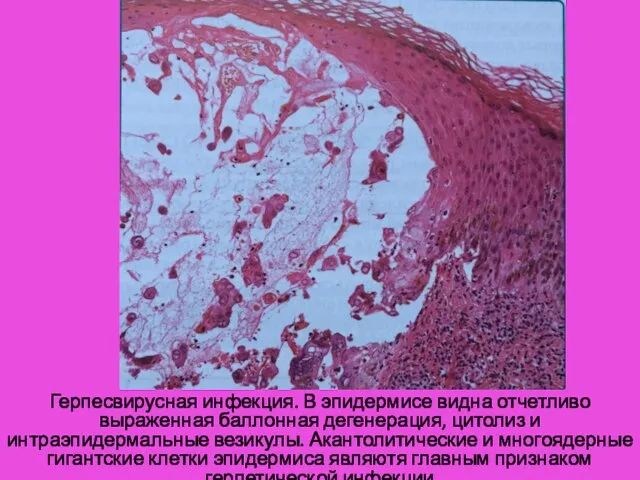 Герпесвирусная инфекция. В эпидермисе видна отчетливо выраженная баллонная дегенерация, цитолиз и