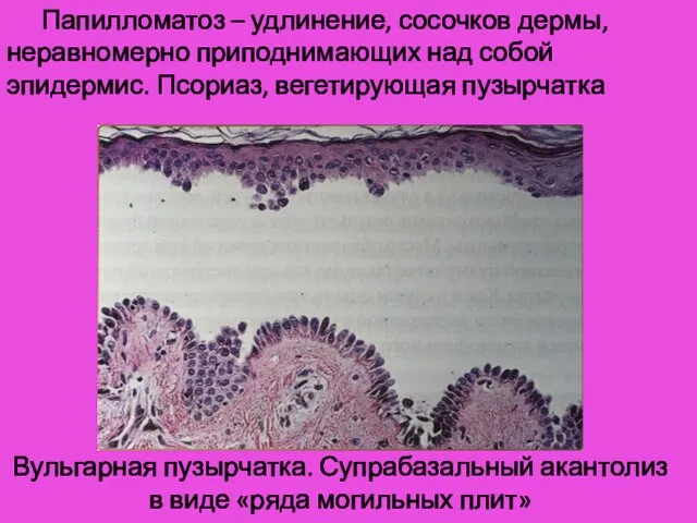 Папилломатоз – удлинение, сосочков дермы, неравномерно приподнимающих над собой эпидермис. Псориаз,