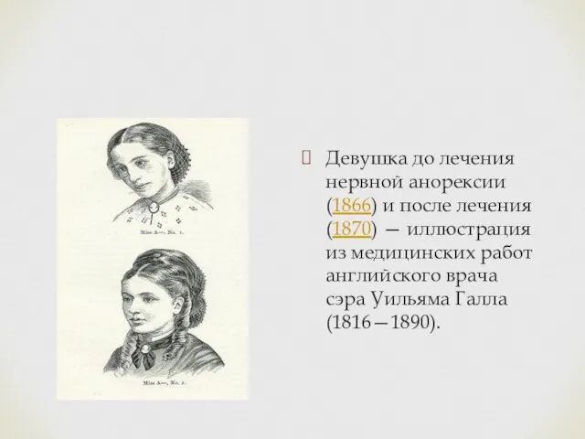 Девушка до лечения нервной анорексии (1866) и после лечения (1870) —