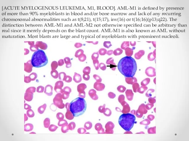 [ACUTE MYELOGENOUS LEUKEMIA, M1, BLOOD]. AML-M1 is defined by presence of