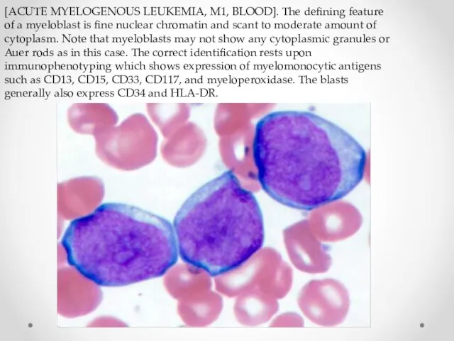 [ACUTE MYELOGENOUS LEUKEMIA, M1, BLOOD]. The defining feature of a myeloblast