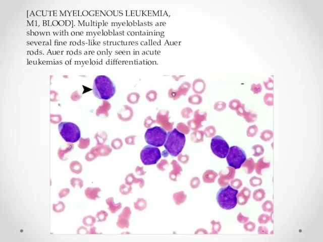 [ACUTE MYELOGENOUS LEUKEMIA, M1, BLOOD]. Multiple myeloblasts are shown with one