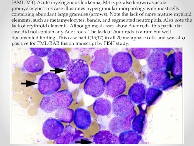 [AML-M3]. Acute myelogenous leukemia, M3 type, also known as acute promyelocytic.This