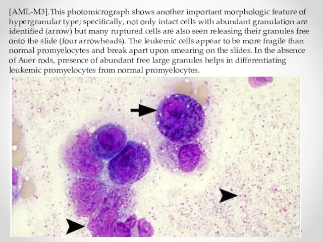 [AML-M3].This photomicrograph shows another important morphologic feature of hypergranular type; specifically,