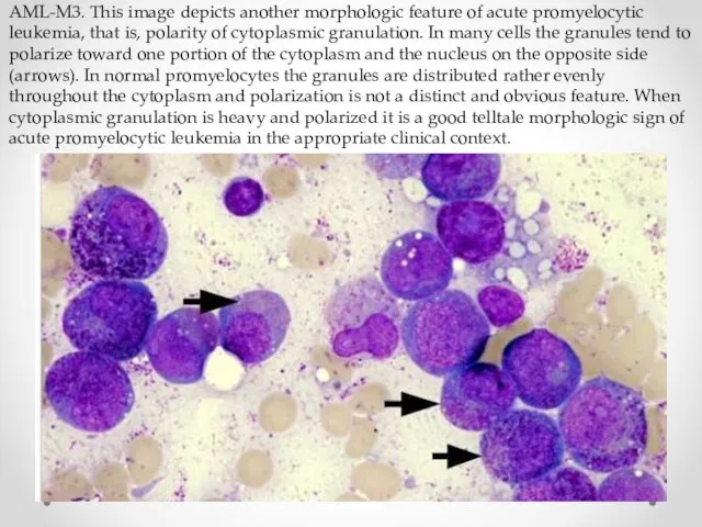 AML-M3. This image depicts another morphologic feature of acute promyelocytic leukemia,