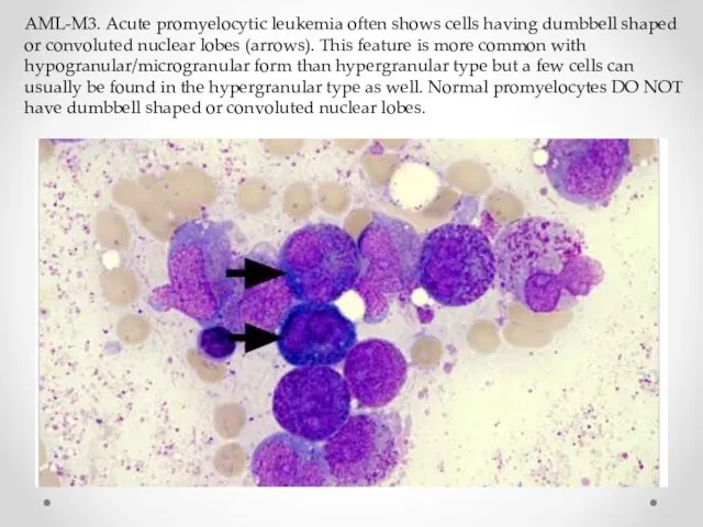 AML-M3. Acute promyelocytic leukemia often shows cells having dumbbell shaped or