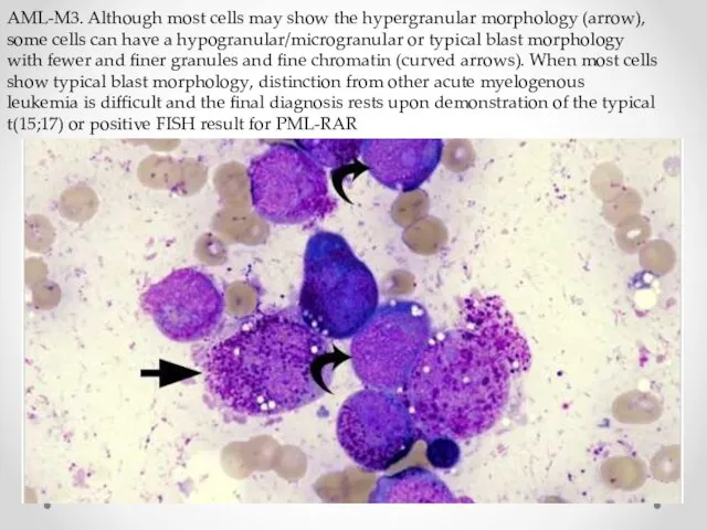 AML-M3. Although most cells may show the hypergranular morphology (arrow), some