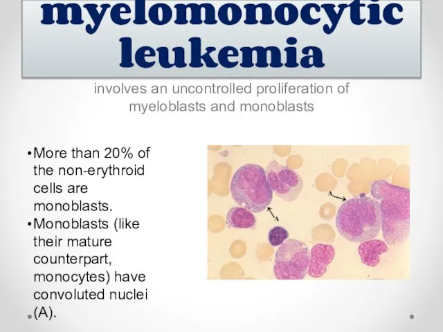 involves an uncontrolled proliferation of myeloblasts and monoblasts Acute myelomonocytic leukemia
