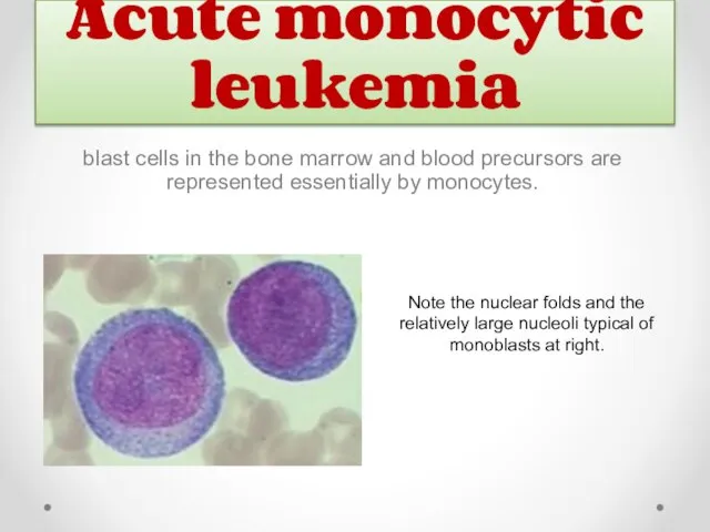 Acute monocytic leukemia Note the nuclear folds and the relatively large