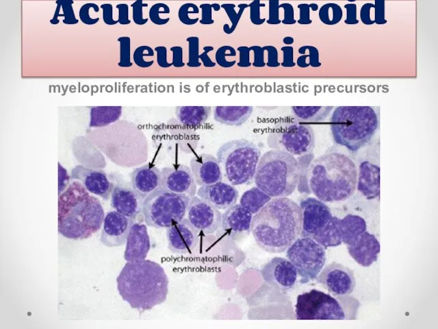 Acute erythroid leukemia myeloproliferation is of erythroblastic precursors