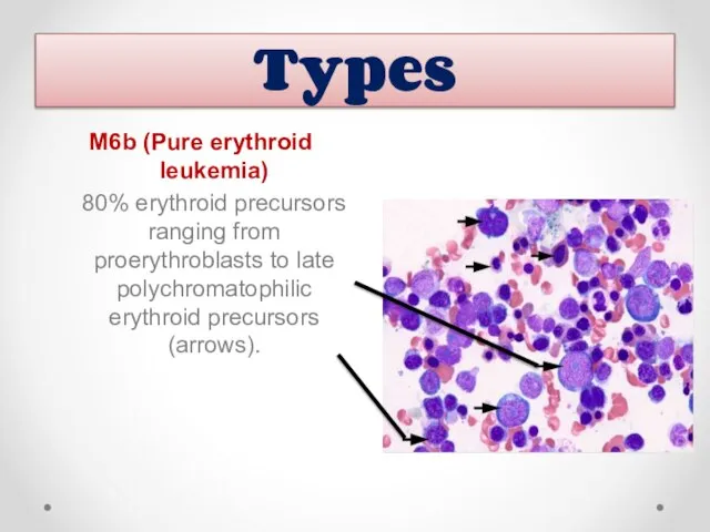 M6b (Pure erythroid leukemia) 80% erythroid precursors ranging from proerythroblasts to