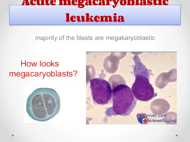 Acute megacaryoblastic leukemia majority of the blasts are megakaryoblastic How looks megacaryoblasts?