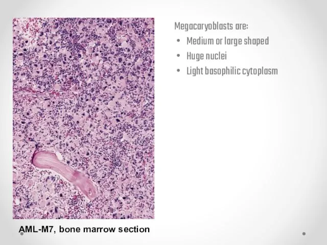 AML-M7, bone marrow section Megacaryoblasts are: Medium or large shaped Huge nuclei Light basophilic cytoplasm