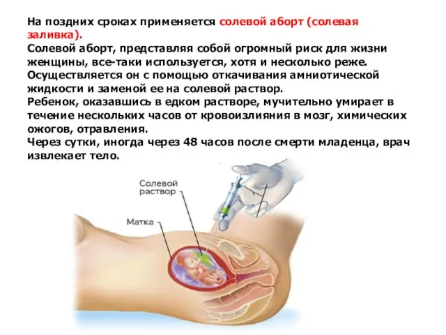 На поздних сроках применяется солевой аборт (солевая заливка). Солевой аборт, представляя