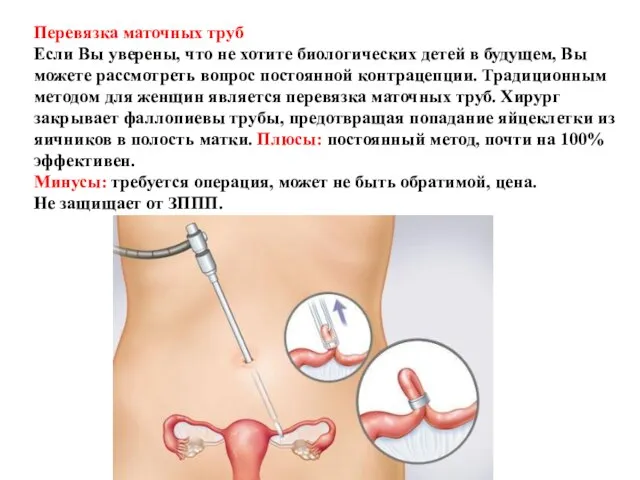 Перевязка маточных труб Если Вы уверены, что не хотите биологических детей