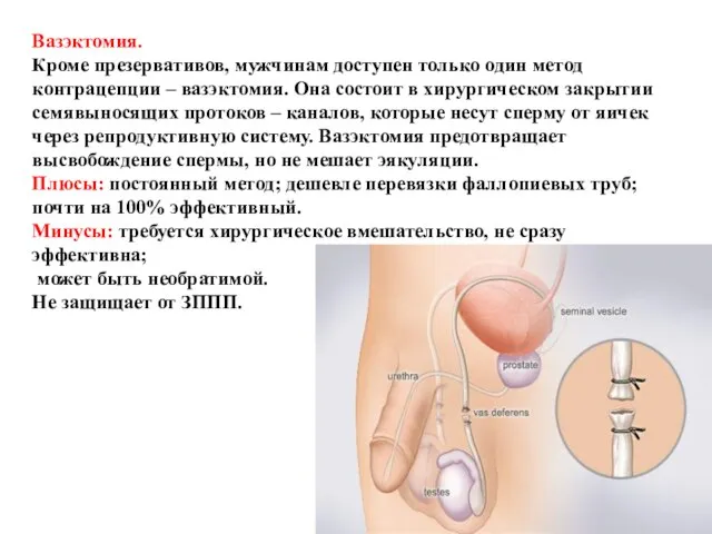 Вазэктомия. Кроме презервативов, мужчинам доступен только один метод контрацепции – вазэктомия.