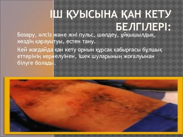 ІШ ҚУЫСЫНА ҚАН КЕТУ БЕЛГІЛЕРІ: Бозару, әлсіз және жиі пульс, шөлдеу,