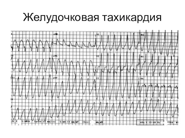 Желудочковая тахикардия