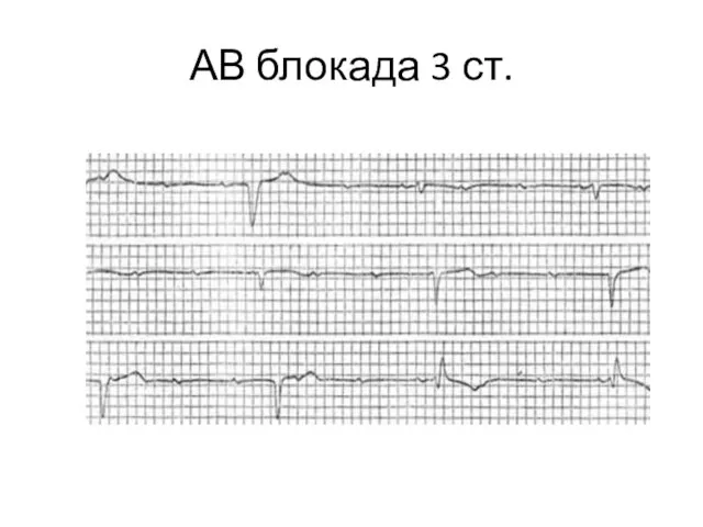 АВ блокада 3 ст.