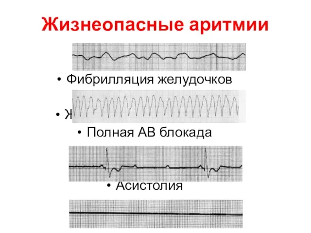 Жизнеопасные аритмии Фибрилляция желудочков Желудочковая тахикардия Полная АВ блокада Асистолия