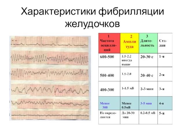 Характеристики фибрилляции желудочков