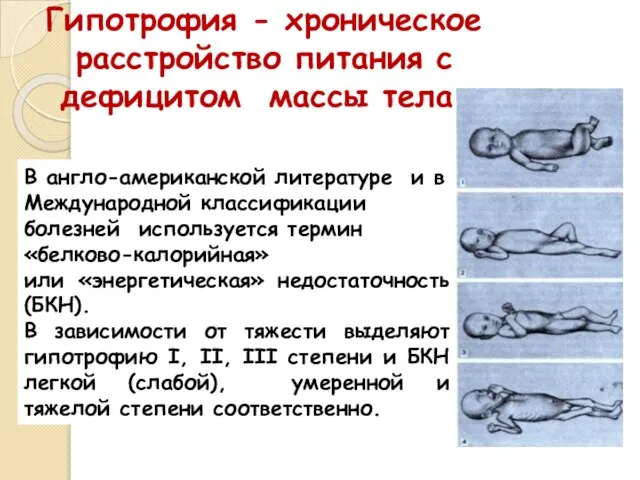 Гипотрофия - хроническое расстройство питания с дефицитом массы тела. В англо-американской