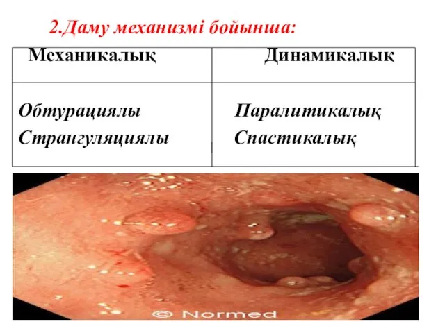 2.Даму механизмі бойынша: Механикалық Динамикалық Обтурациялы Паралитикалық Странгуляциялы Спастикалық